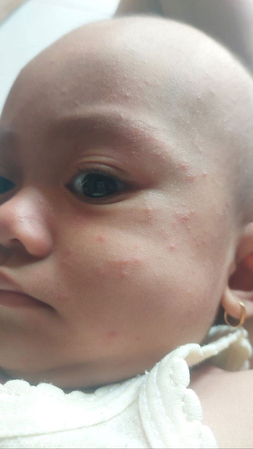 Bintik merah dan gatal