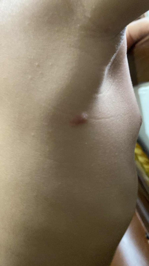 Bentol merah pada bayi