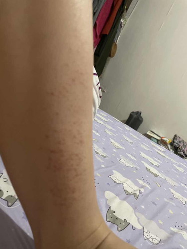 Gatal di kaki trimester 3