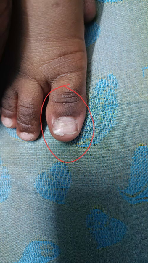 My son's left foot big toe nail turned like this... anyone know why? BB
