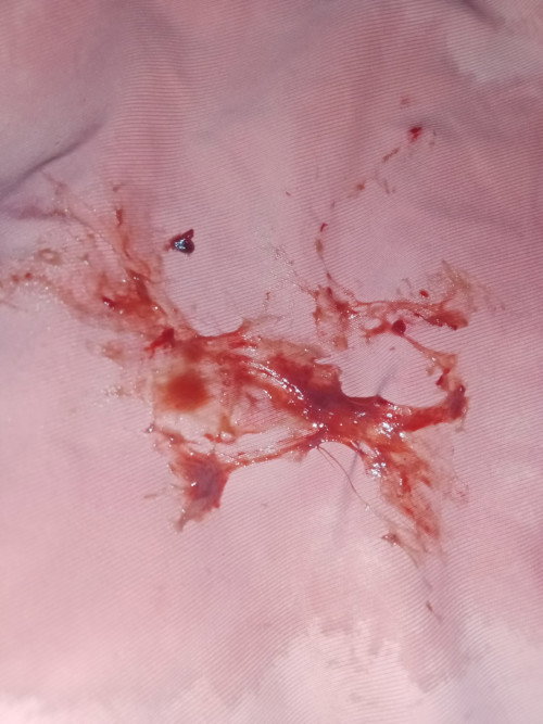 Red w/ brownish blood Po implantation bleeding Po ba yon