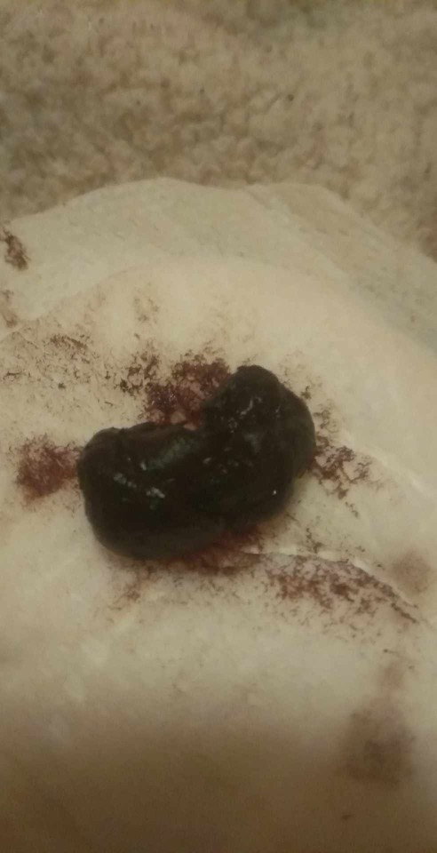 Ano kaya ito? 10 weeks pregnant