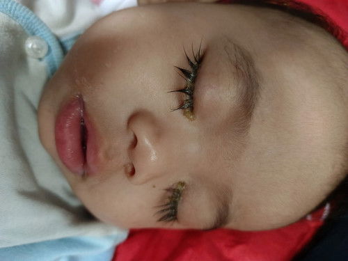 Tahi mata baby banyak petanda sakit mata atau normal ye?