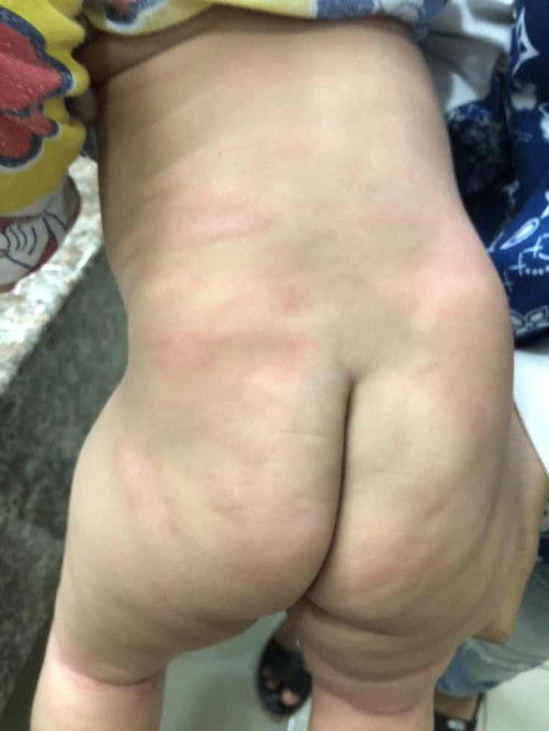 ผดผื่นสีแดงกังวลใจสำหรับเเม่