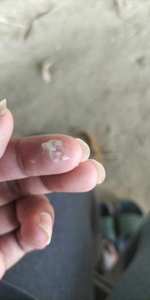 สอบถามคะเเม่ๆเเบบนี้คือตกขาวหรือมูกใสค่ะ