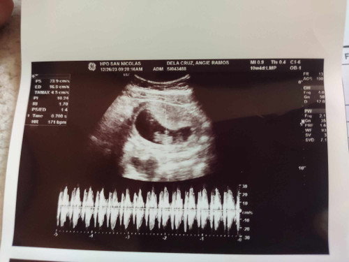 God is Good. Live si baby ko at may heartbeat na at 10 weeks