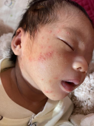 Như này là bị mụn sữa hay chàm vậy các mom. Mình bôi kem dưỡng Dizigone mà tình trạng chưa thấy giảm