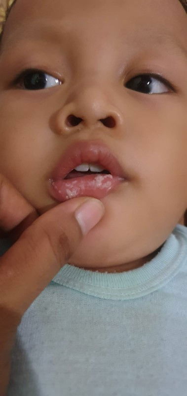 Infeksi jamur atau sariawan