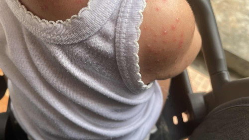 Ini cacar atau bukan?