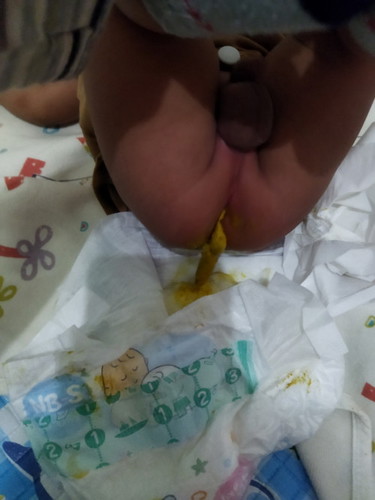 Maaf jorok, Bun apa ini termasuk sembelit yaaa, pup nya padat ga encer kyk biasanya.
