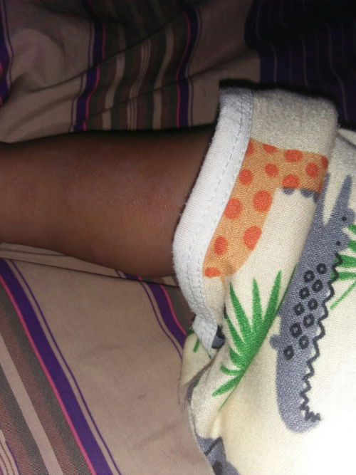 Gatal pada anak usia 4 bln