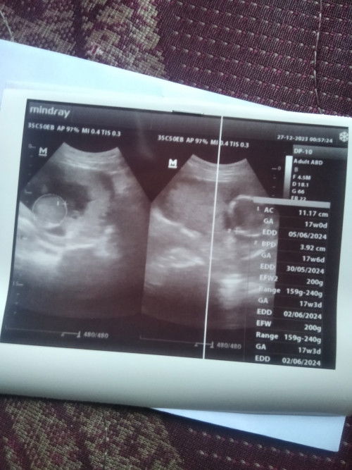 Alhamdulillah USG pertama semua sehat usia kehamilan 17w3d😘🙏