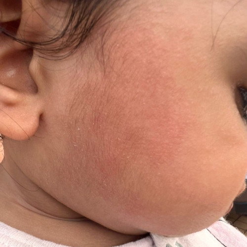 Pipi baby naik bintik2 merah