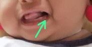 Gusi bayi 3 bulan ada benjolan