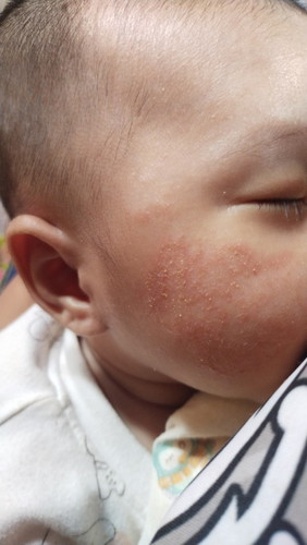 แก้มลูกเป็นแบบนี้ ทำยังไงให้หายค่ะ