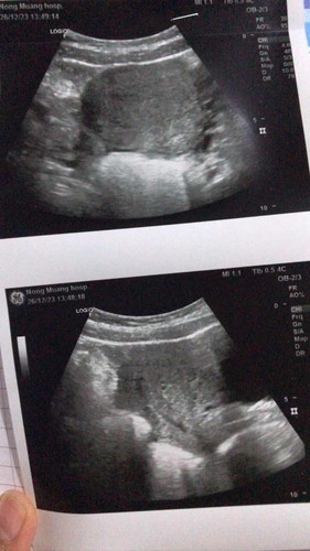 ท้องได้5week แต่ไปซาวด์ไม่เจออะไรเลยแบบนี้ผิดปกติมั้ย ถุงตั้งครรภ์รึตัวอ่อนก็ไม่เจอเลย