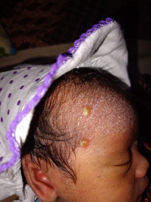 Bunda" disnih ada yang tau gak ini anak saya kenapa yah kulitnya pada melepuh kaya gini