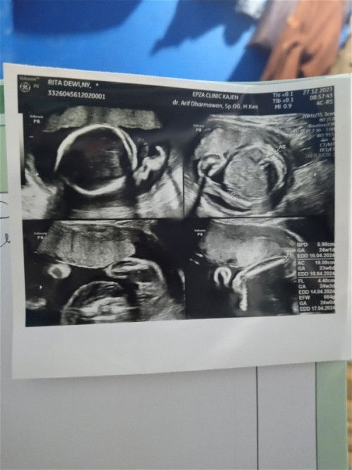 hasil usg 23 week, ada yang udah usg juga ga?