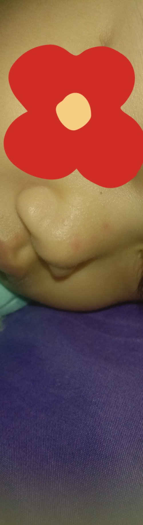 Beruntusan pada hidung