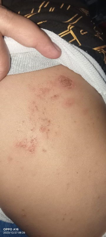 Cacar atau bukan ya?