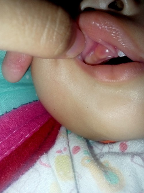 Apakah ini sariawan pada bayi ku bunda?? Tolong di bantu rekomendasi obat nya ya bun