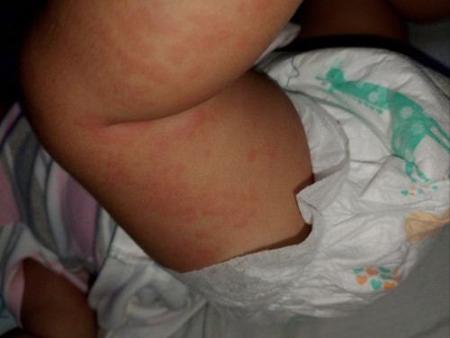 biglang tumubo sa katawan ni baby