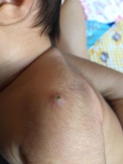 ตุ่มปลูกฝี 1เดือน9วันค่ะ