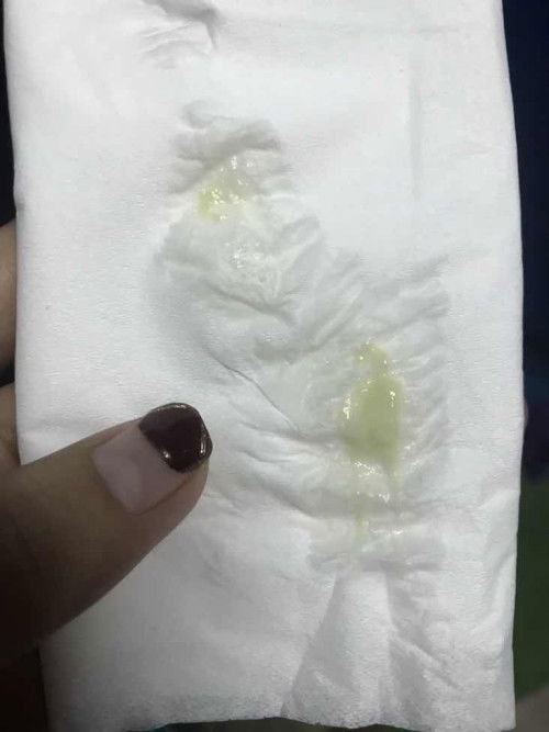 Keputihan kehamilan 5w3d