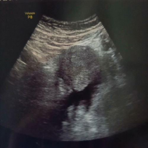 Suspect hamil ektopik