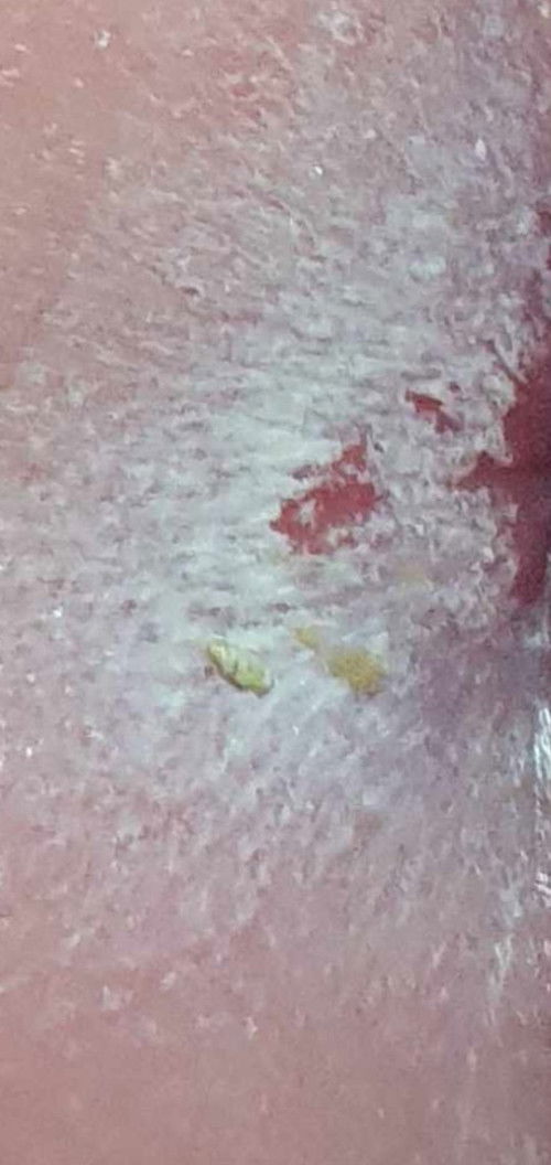 Ano po ginagamot nyo po sa bum ni baby pag ganito po