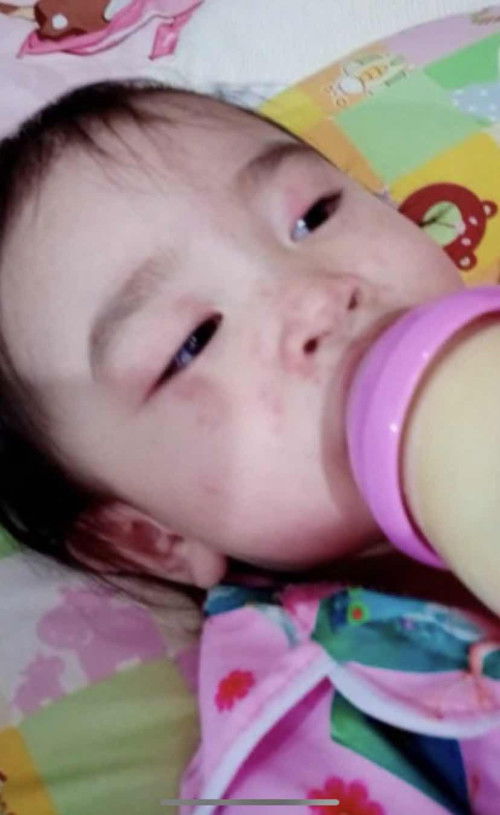 ลูกหน้าเป็นผื่นแดง