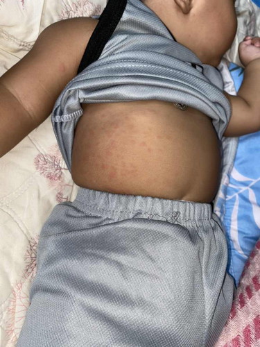 ลูกมีผื่นแดงตามตัว