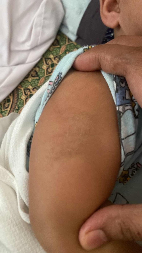 kulit mengelupas tapi fully df