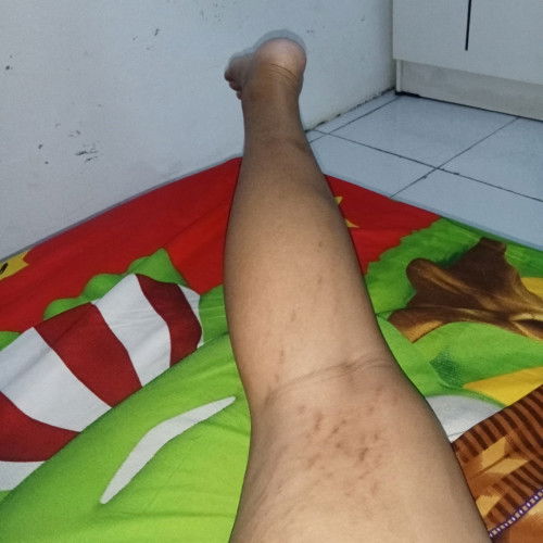 Pengen ngilangin strechmark