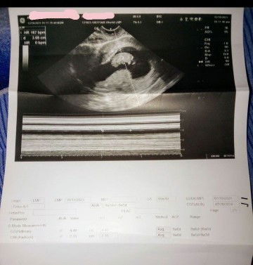 after 1 week trans-v uts .. I'm 10 weeks and 2 days now .. tem _July here ,...