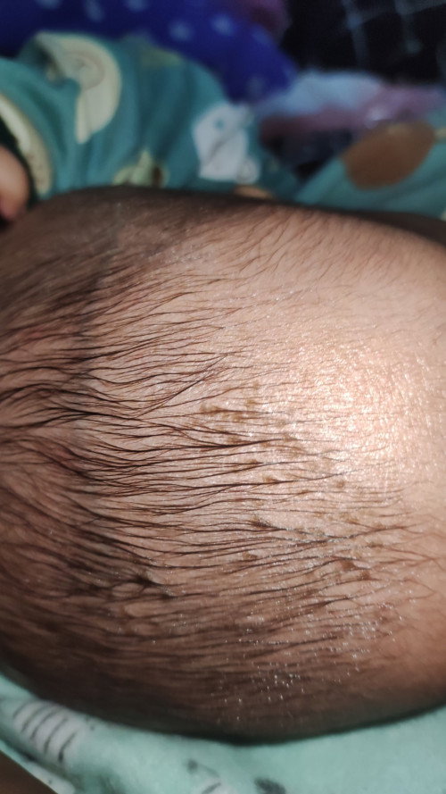 Kerak di kepala bayi