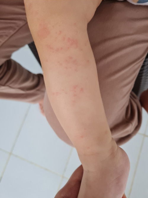 Bintik merah pada kaki anak 1 tahun 2 bulan