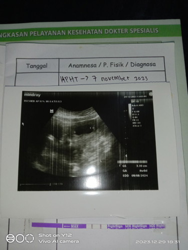 Tadi kan saya USG baru 8 week apah wajar baru kelihatan kantung nya doang?