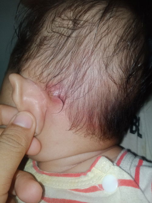 Benjolan belakang telinga