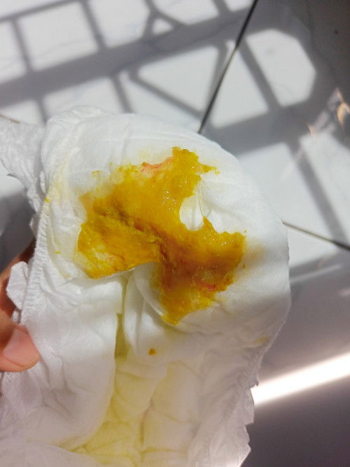 Diare berlendir anak umur 1,5 tahun