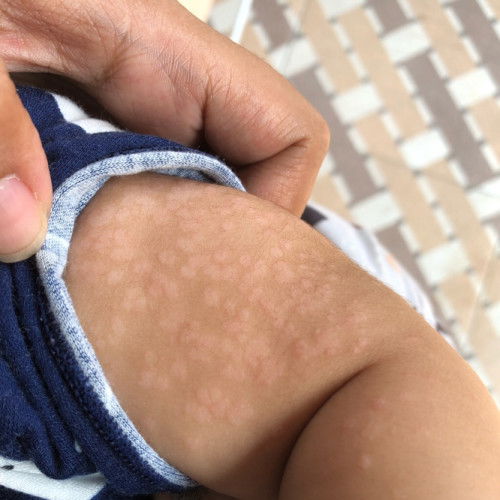 Bercak-bercak putih seperti panu