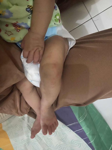 Bentol bentol merah pada bayi 3 bulan