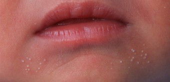 Milia / bintik putih bayi baru lahir