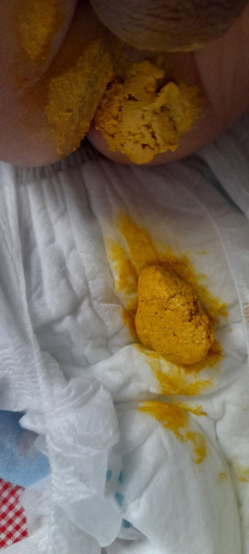 Maaf bun kalo jorok, pup.bayi 3 bulan seperti itu sembelit bukan ya?