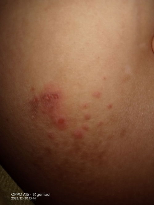 Gatal bintik bintik keluar air bening dikasih obat apa ya bun saya hamil 8minggu apakah boleh salep