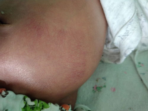 ทารกท้องโต