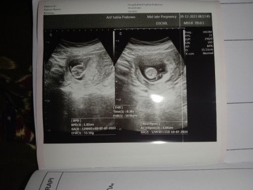 MasyaaAllah Tabarakallah.
USG di usia kandungan 12weeks1day.