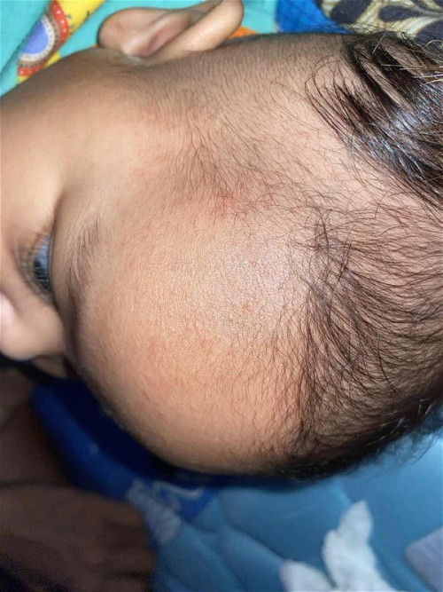 bintik kecil seperti biang keringat