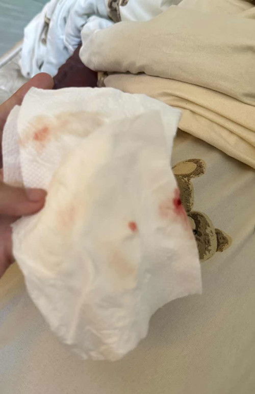 36สัปดาห์ มีเลือดออก