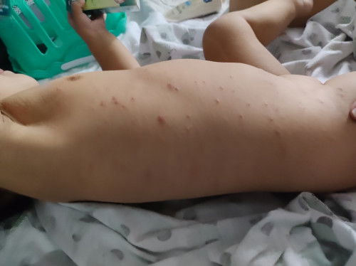 Anong klaseng rash po kaya ito